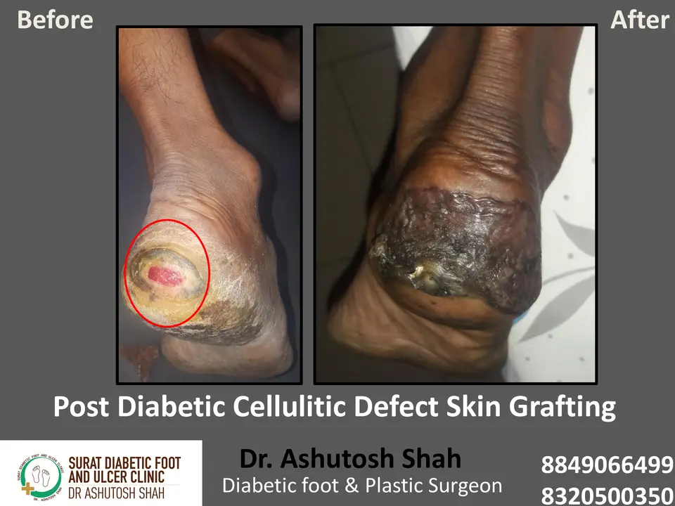 Diabetic Cellulitis and Coverage.pptx-14.webp